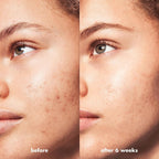 e.l.f. SKIN Blemish Breakthrough Triple-Acid Resurfacing Serum. Hydrating Night Serum For Fighting Blemishes. Helps Improve Skin Tone & Texture
